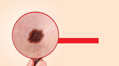 Actinic Keratosis: Don't Let It Turn Into Skin Cancer