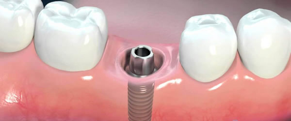 Billing, Dental, Implants, Prosthesis Designed, Dentist