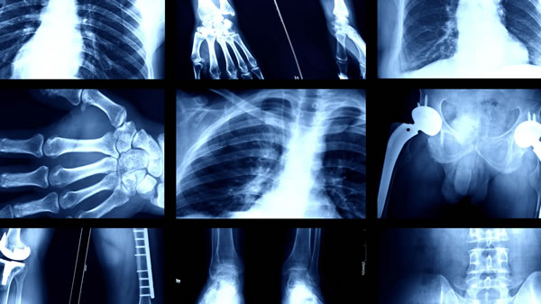 Coding for a Performance of an X-ray Service vs. Counting the Work as a Part of MDM