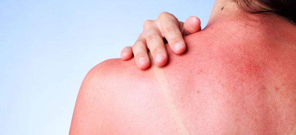 Summer Fun: Be Aware of Sunburns