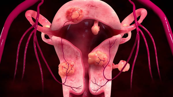 Coding and Documentation for Arterial Embolization, Code 37242