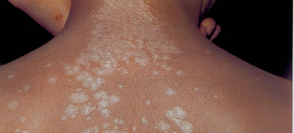 Lichen Planus and Lichen Sclerosus