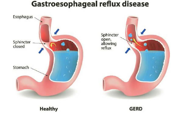 Coding, ICD-10, Gastroesophageal Reflux Disease